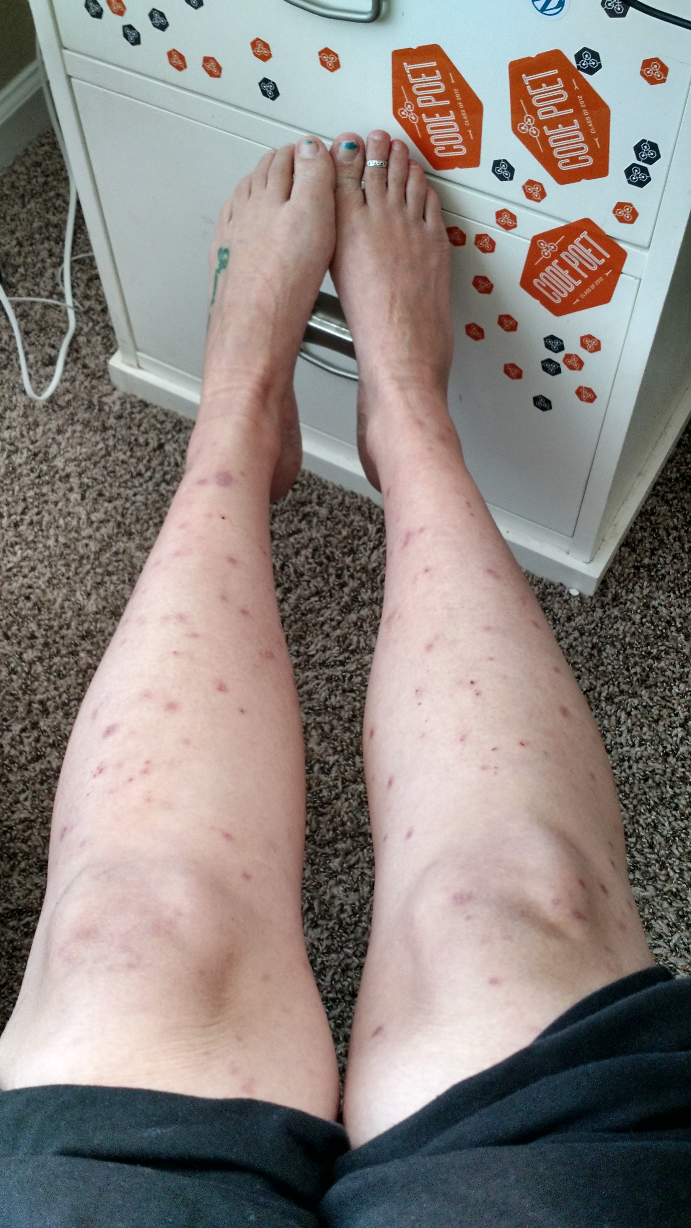 Autoimmune Progesterone Dermatitis – Revelry Reverie